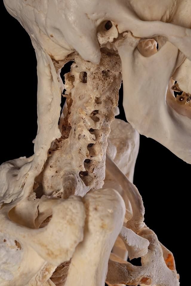 El doctor Raúl Dimumbrún alerta sobre enfermedades infecciosas vertebrales detectadas en Tucupita photo 4942790205991750956 y